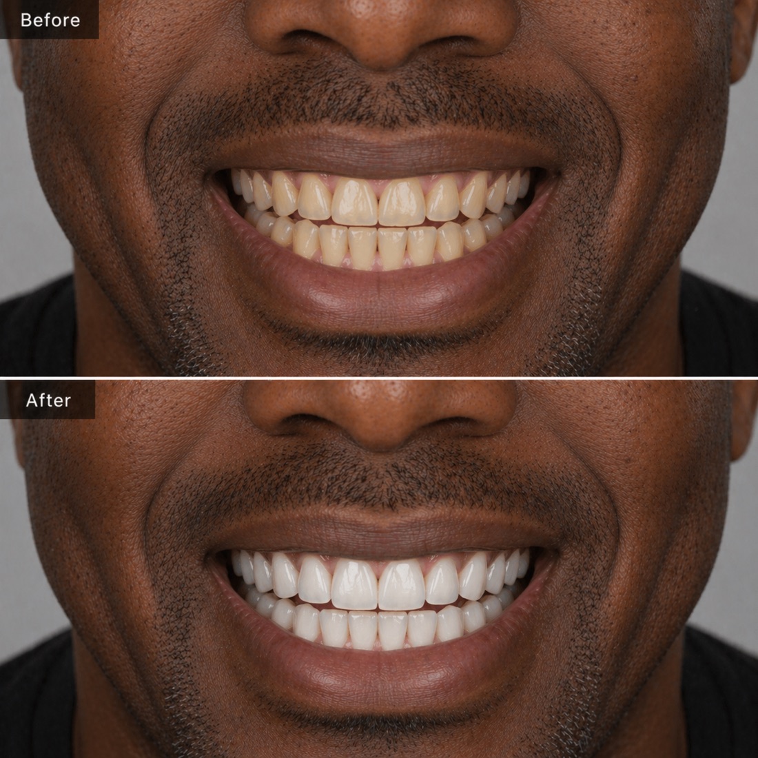 Before and after smile makeover
